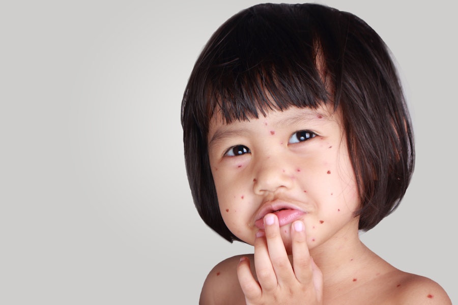 guide santé varicelle enfant